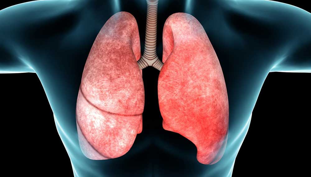 Fibrosi Polmonare Idiopatica